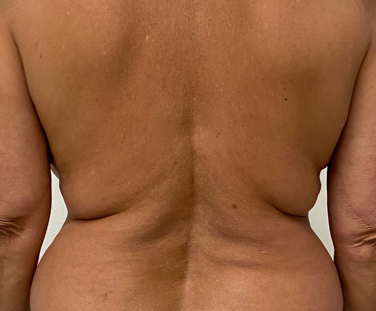 Bra Line Back Lift Before and After